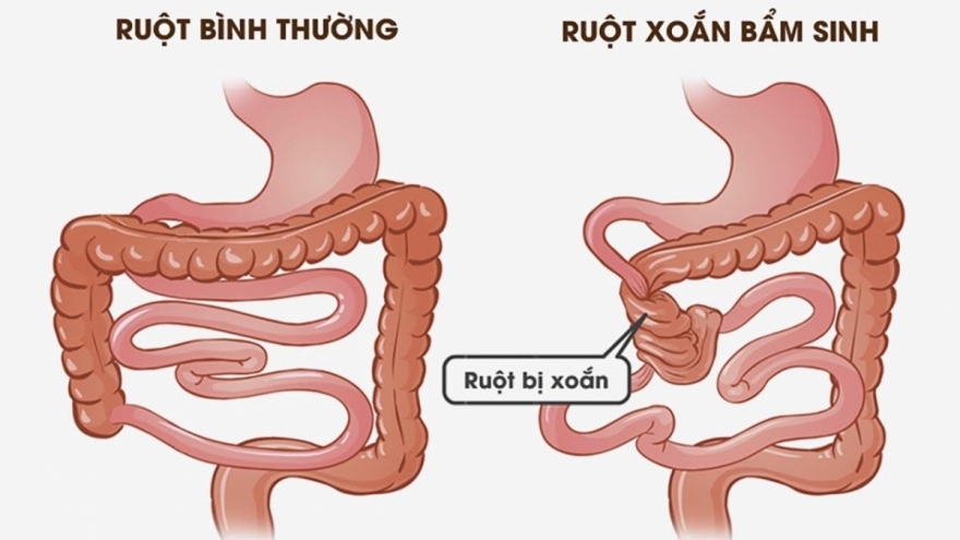 Cứu sống trẻ sơ sinh mắc bệnh hiếm gặp