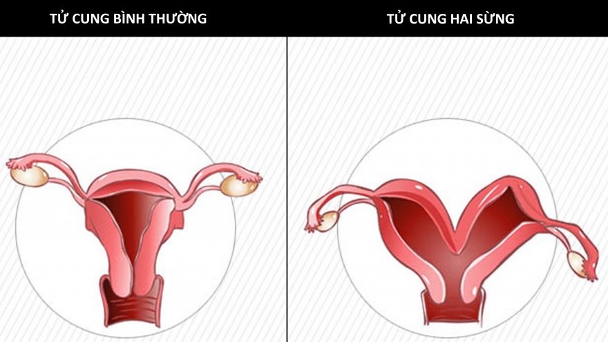 Tử cung hai sừng có ảnh hưởng thế nào, xử trí ra sao?