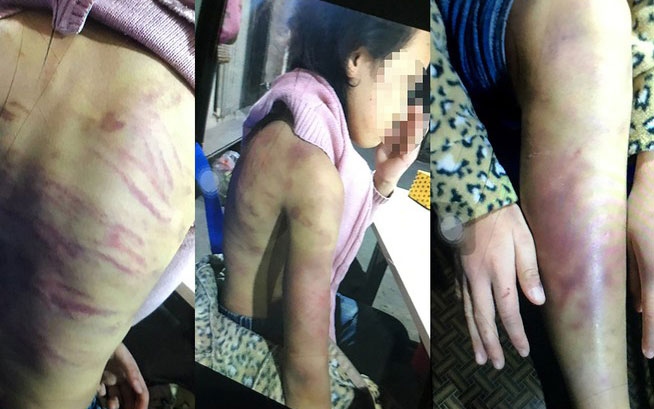 Bé gái 12 tuổi nghi bị bạo hành, xâm hại tình dục: Hà Nội chỉ đạo khẩn