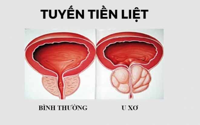 tien-liet-tuyen.jpg