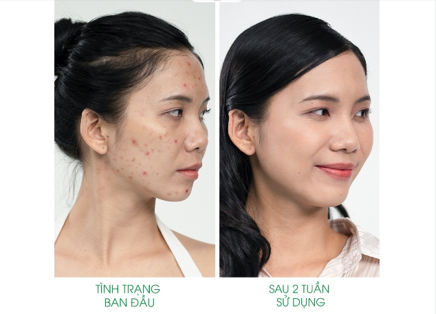 Cùng Thanh lăn mụn MS Cosmetic Trị mụn cấp tốc, tự tin đón lễ 2/9